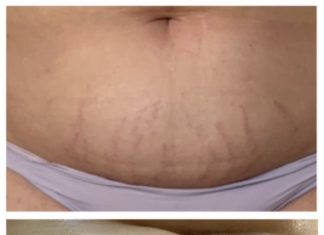 Zabieg ujędrniający Termogenique w Body Evolution Ursus termodenique body evolution